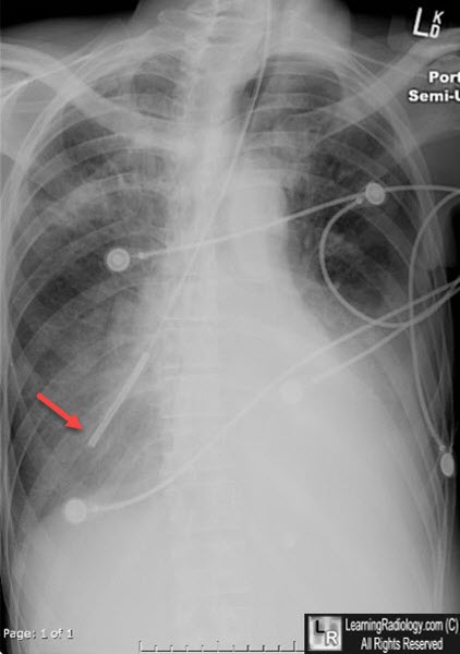 Dobbhoff Tube in Right Lower Lobe